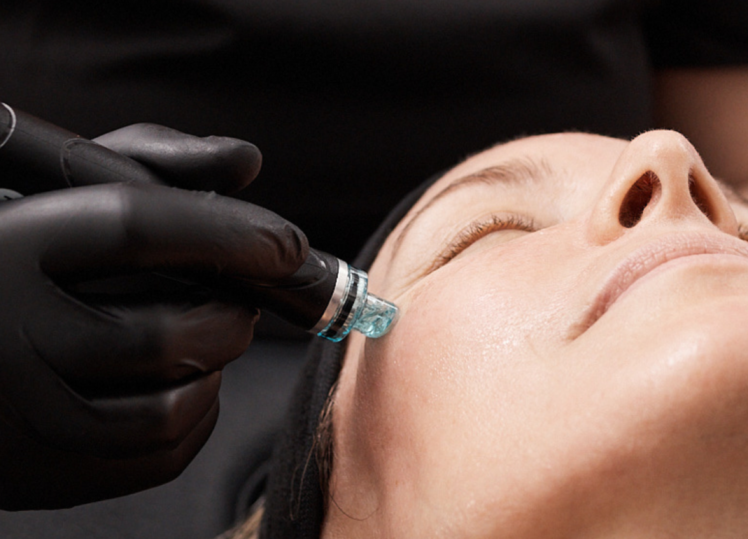 Hydrafacial treatment tip applied to the cheek